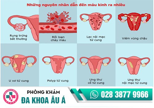 KINH NGUYỆT RA NHIỀU LÀ NHƯ THẾ NÀO?